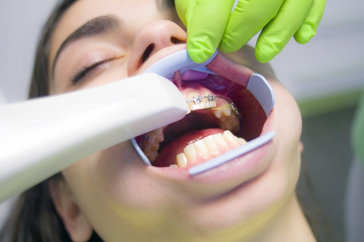 Various Teeth Whitening Options